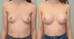 Breast Augmentation - Case 1