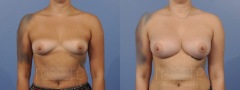 Breast Augmentation - Case 12