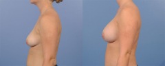 Breast Augmentation - Case 13