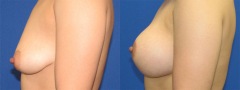 Breast Augmentation - Case 17