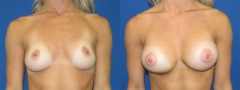 Breast Augmentation - Case 18