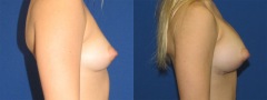 Breast Augmentation - Case 19