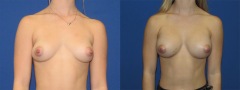 Breast Augmentation - Case 19