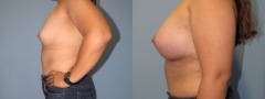 Breast Augmentation - Case 2