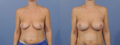 Breast Augmentation - Case 3