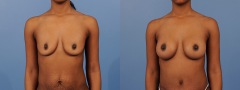 Breast Augmentation - Case 5