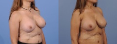 Breast Revision - Case 2