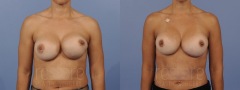 Breast Revision - Case 3