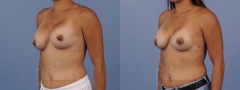 Breast Revision - Case 4
