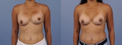 Breast Revision - Case 4