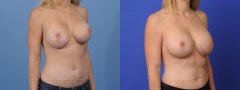 Breast Revision - Case 1