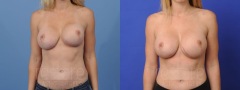 Breast Revision - Case 1