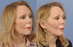 Facial Surgery - Case 1
