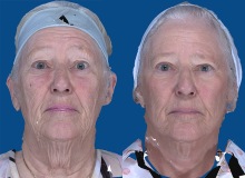 Facial Surgery - Case 2