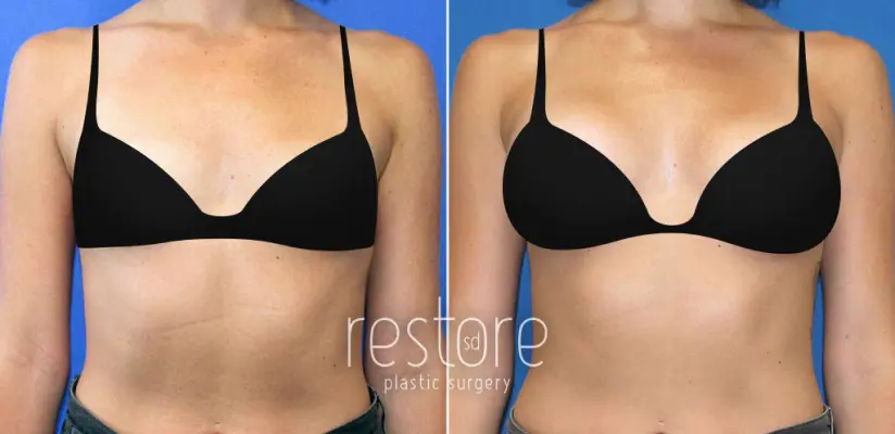Small Breast Size San Diego - Restore SD Plastic Surgery