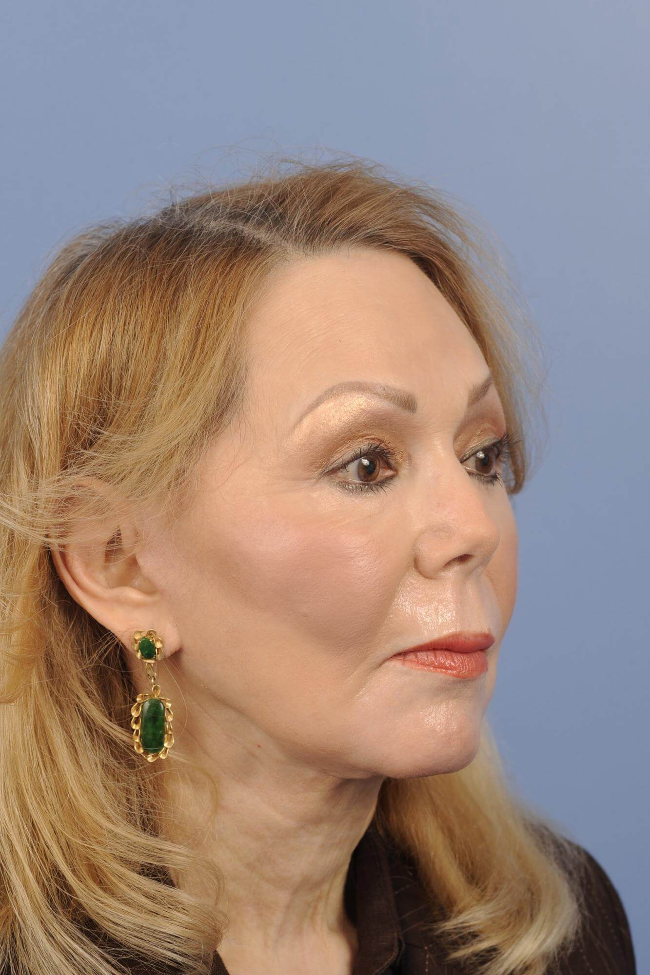 San Diego Facelift Before & After Patient