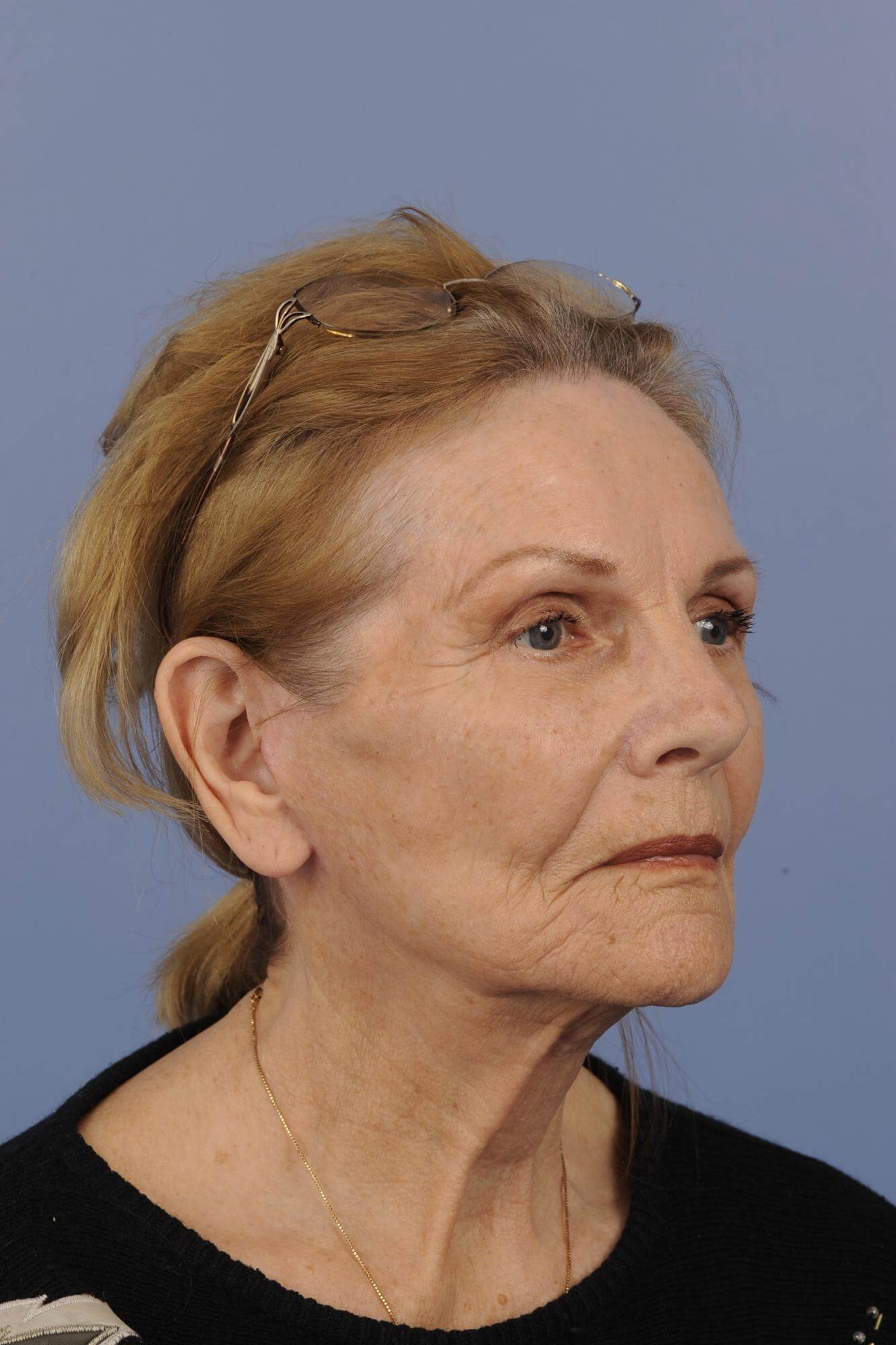 San Diego Facelift Before & After Patient