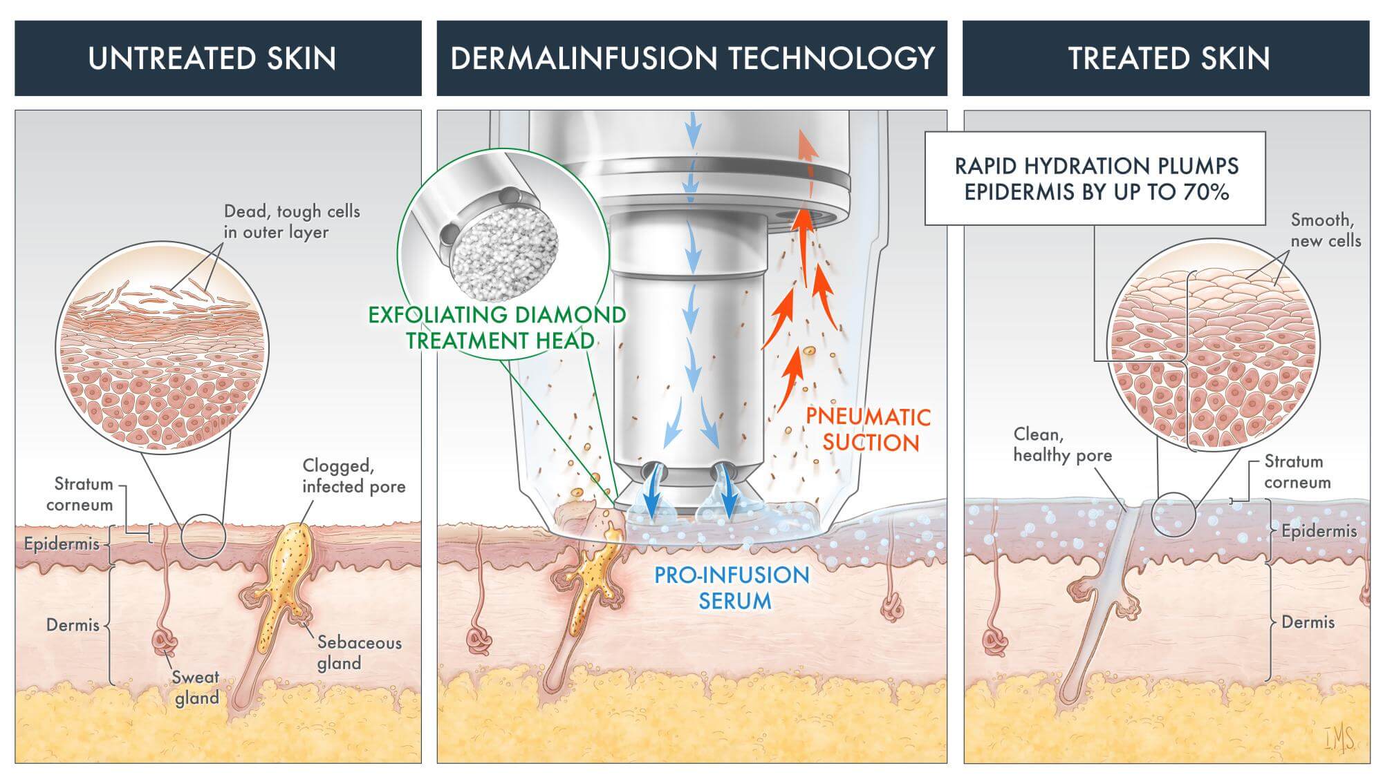 Silk Peel Dermalinfusion