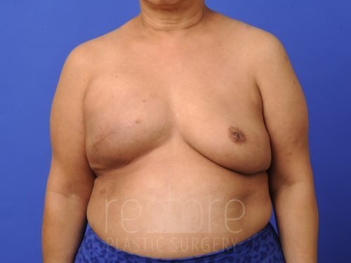 , Breast Reconstruction Case #427