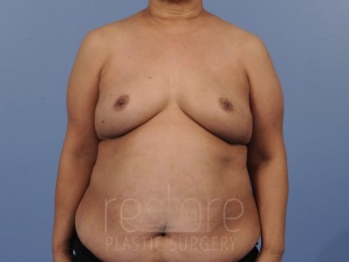San Diego Breast Reconstruction Before & After Patient