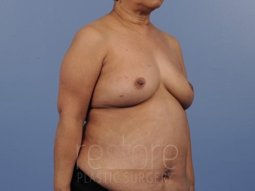 , Breast Reconstruction Case #427