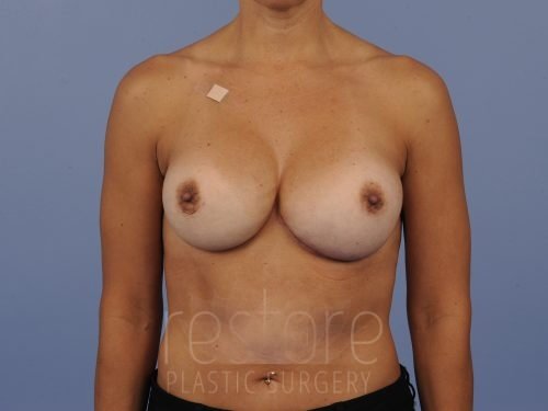, Breast Revision Case #792