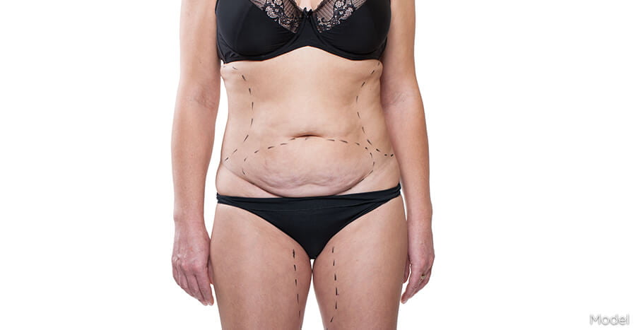 Woman with pre-surgery markings, highlighting loose skin and excess fat. 