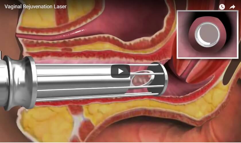 vaginal-rejuvenation laser