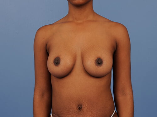 , Breast Augmentation Case #490