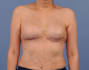 , Breast Reconstruction