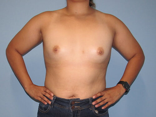 , Breast Augmentation Case #5