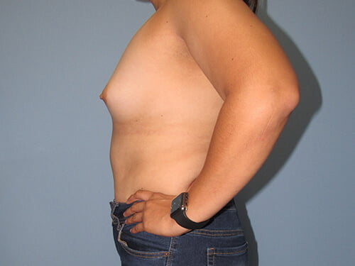 , Breast Augmentation Case #5