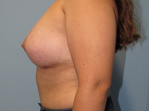 , Breast Augmentation Case #5