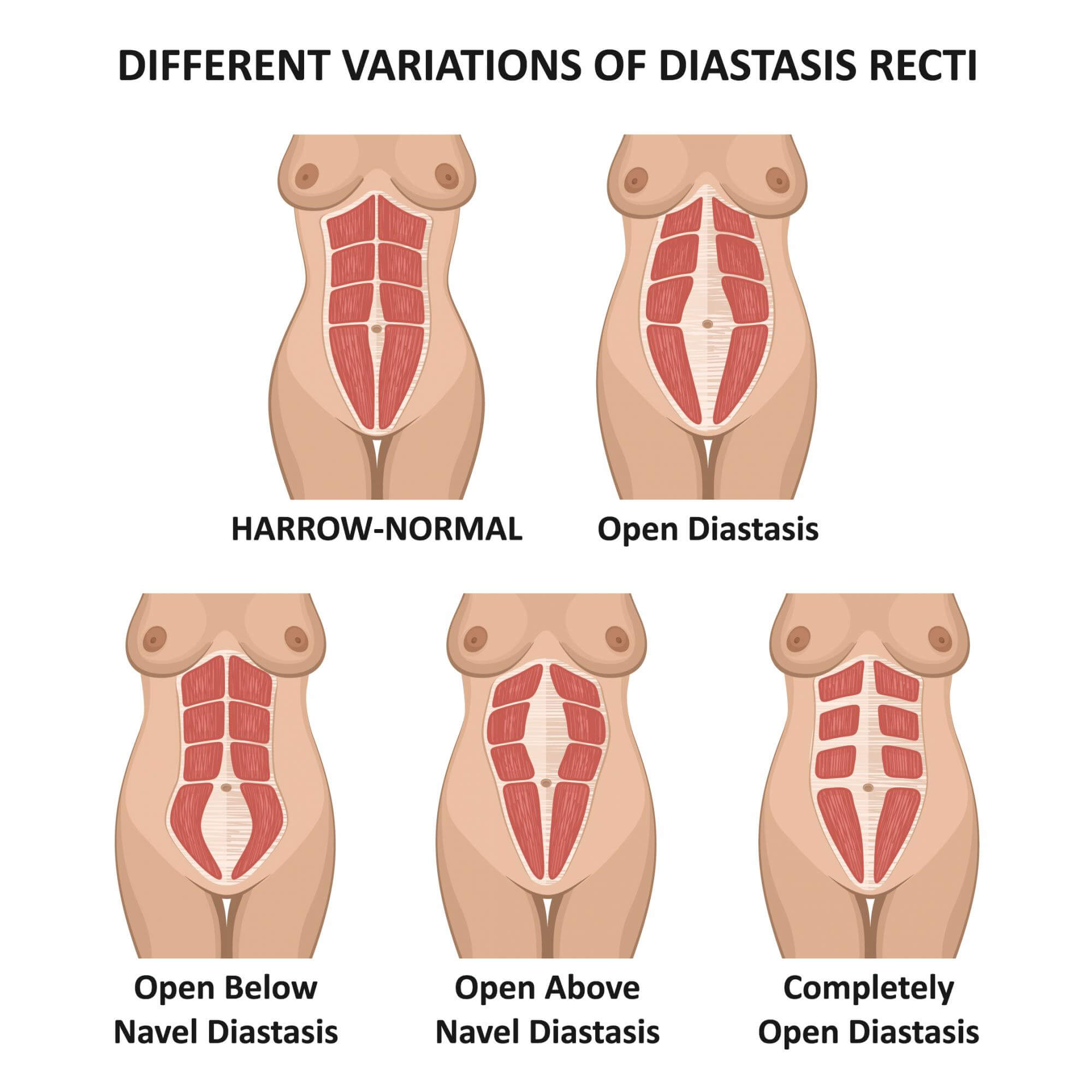 Variations of Diastasis Recti based on the location of the separated abdomnial muscles