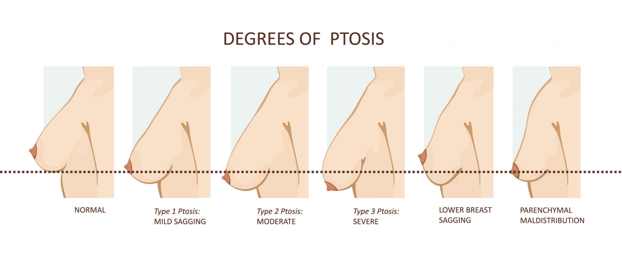 Sagging Breasts San Diego - Restore SD Plastic Surgery