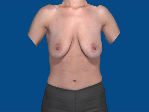 , Breast Augmentation Case #11