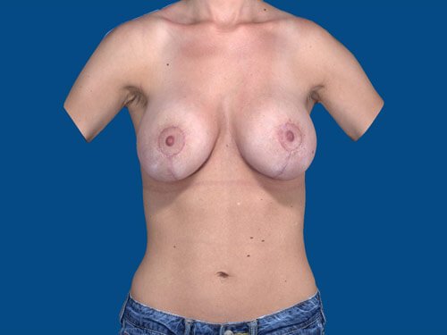 , Breast Augmentation Case #11