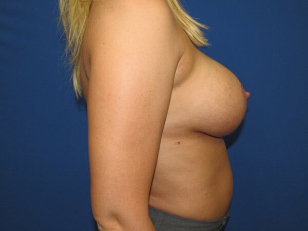 , Breast Augmentation Case #16