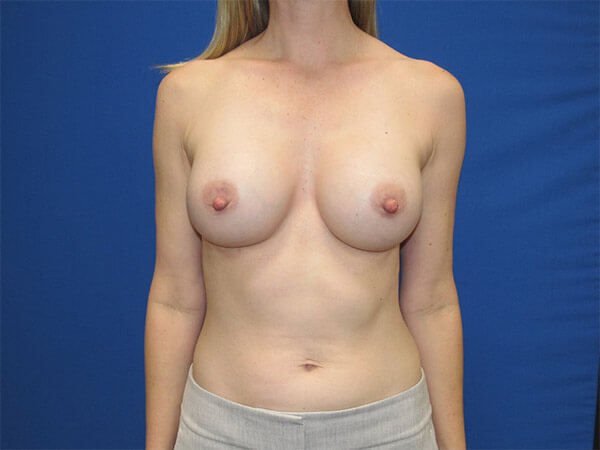 , Breast Augmentation Case #12