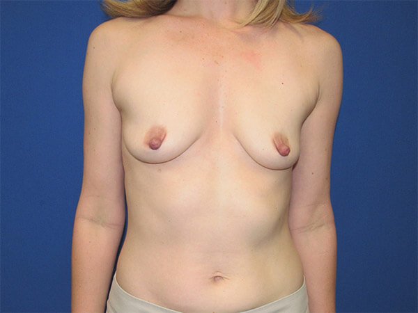, Breast Augmentation Case #12