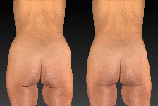 Brazilian Butt Lift 3D Animation