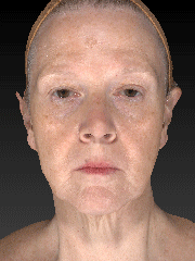 Face Lift 3D Animation