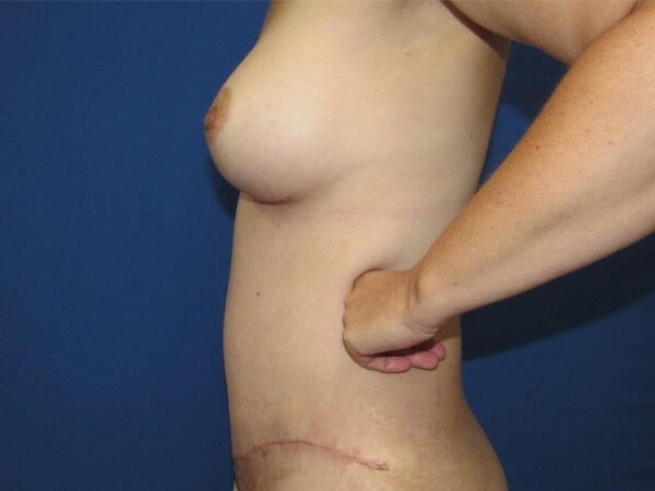 , Mommy Makeover Case #08