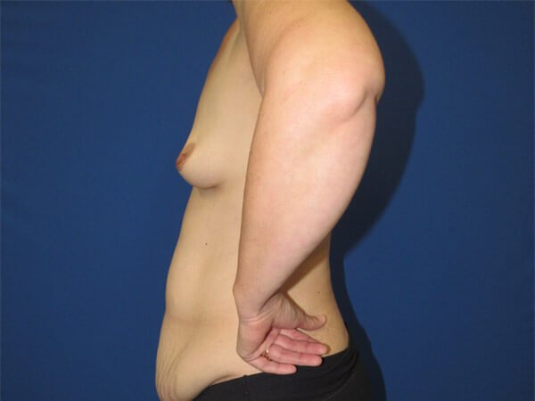 , Mommy Makeover Case #08