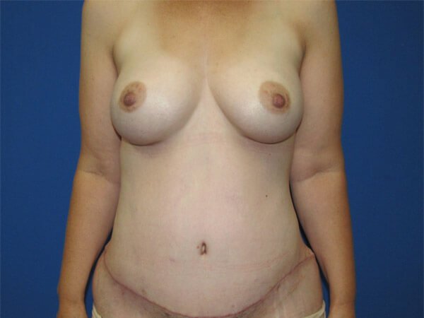 , Mommy Makeover Case #08