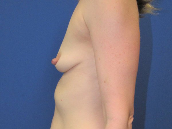 , Breast Augmentation Case #12