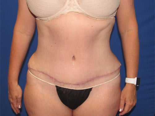 , Tummy Tuck Patient #13