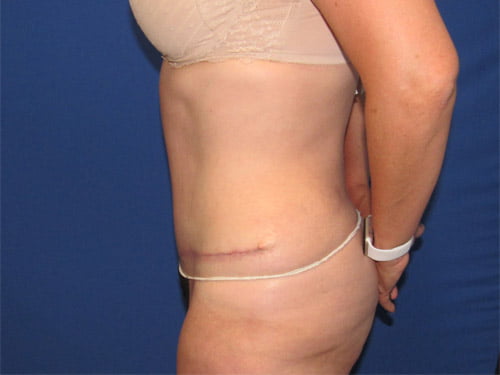 , Tummy Tuck Patient #13