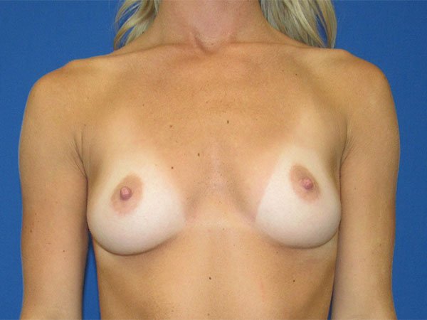 , Breast Augmentation Case #18