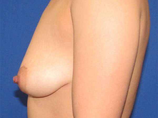 , Breast Augmentation Case #17